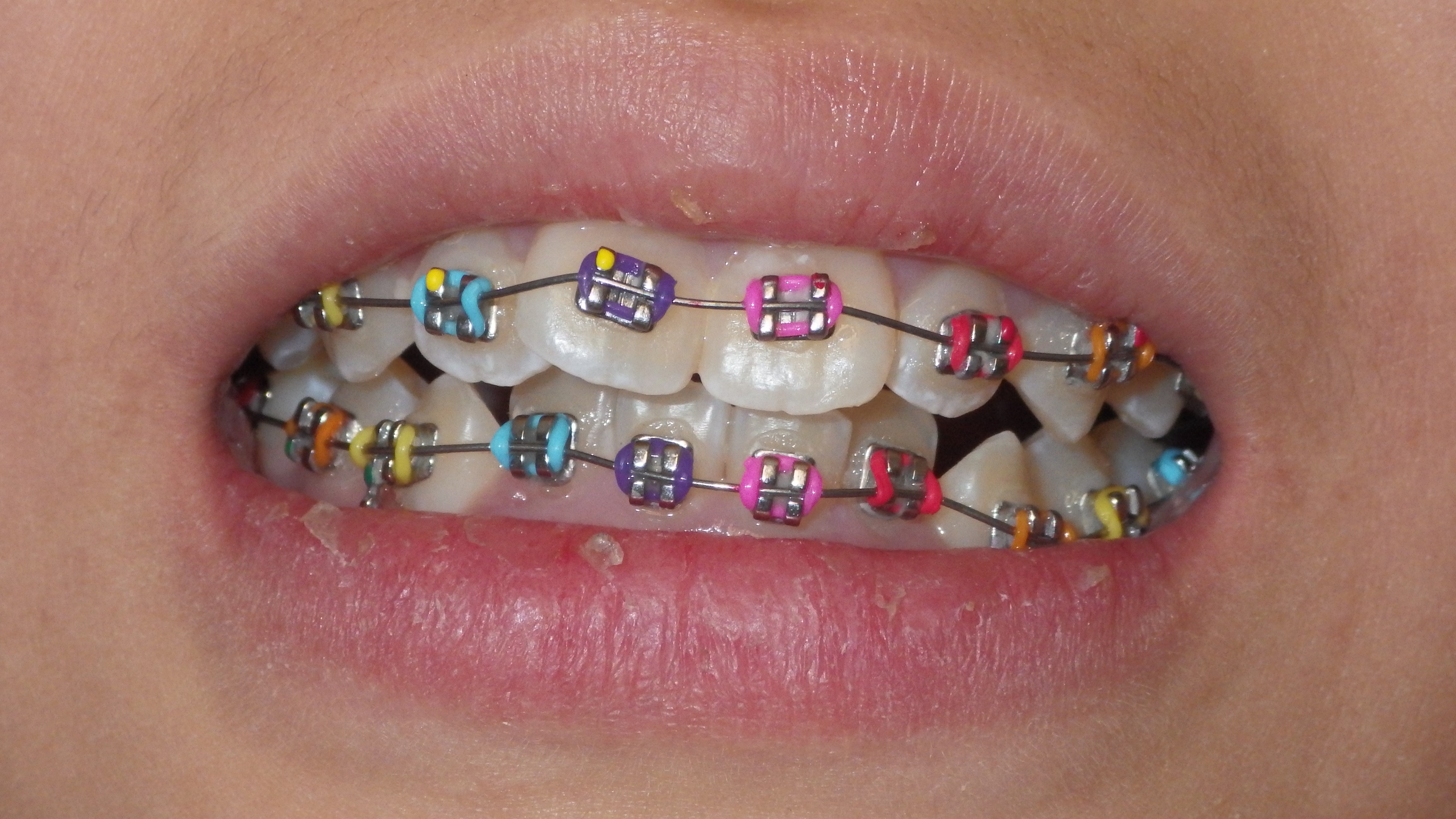 Kimler Ortodontik Tedavi Görebilir?